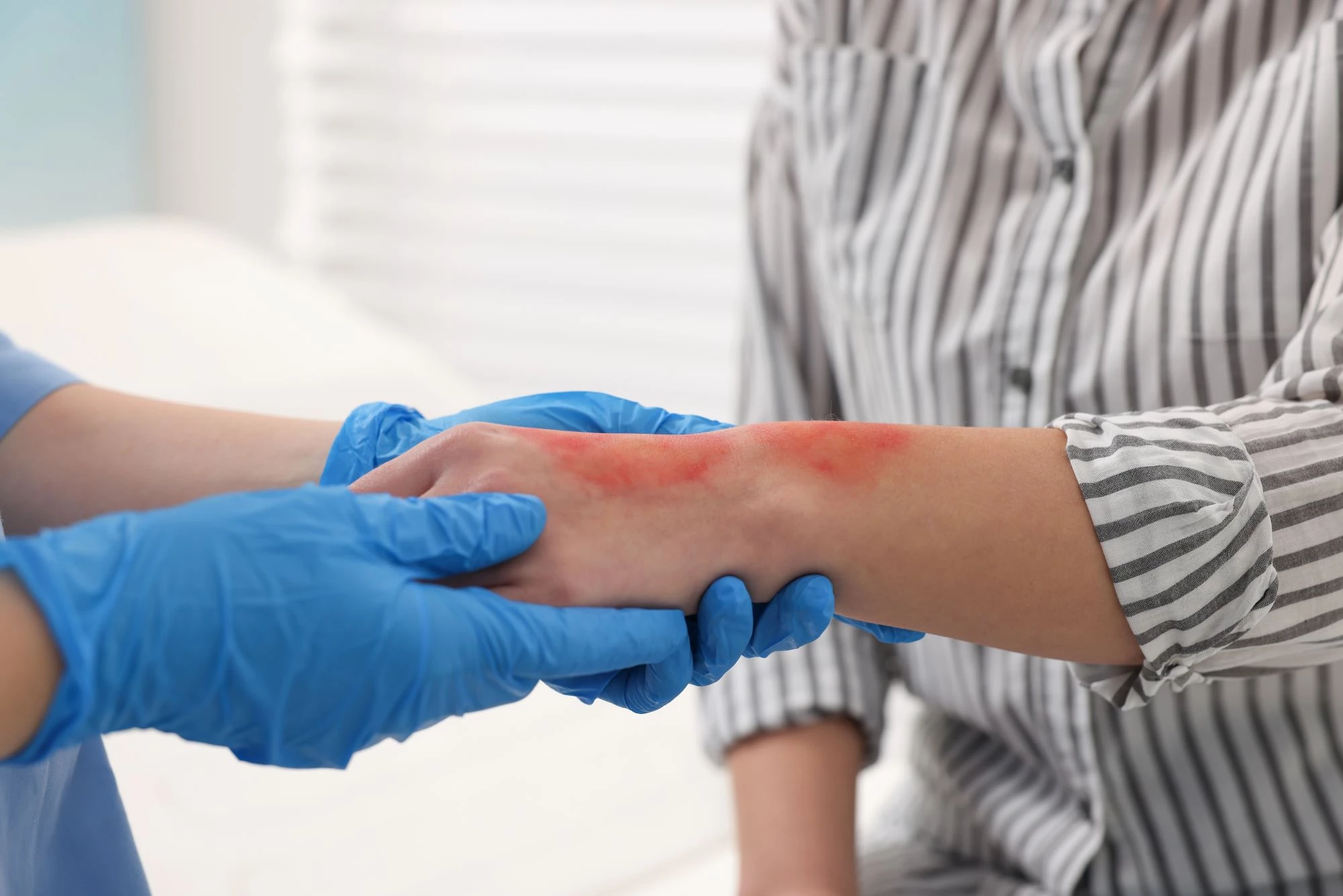 Burn injury affecting skin and underlying tissues of varying severity